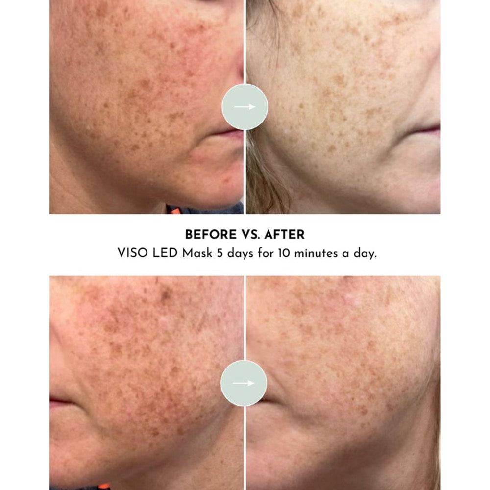 VISO - FDA Certified Red Light Therapy Mask